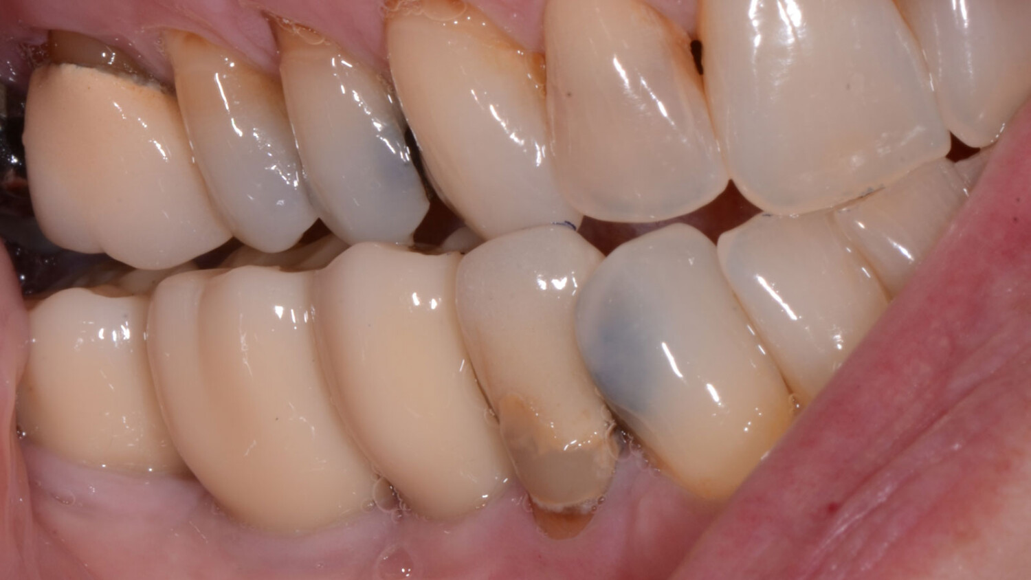 Mandibular Alveolar Ridge Split with Delayed Implant Placement - Geistlich