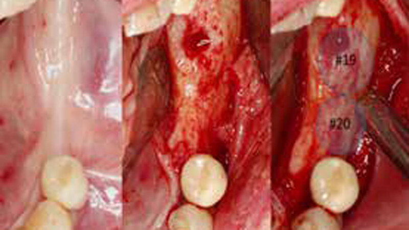 Bone reconstruction: (a) a full-thickness flap was elevated in