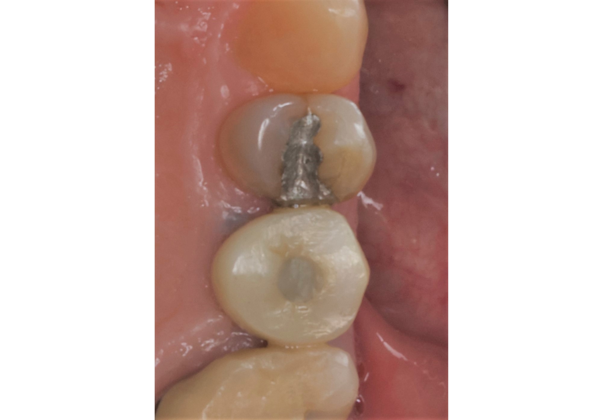 18 - Final restoration, occlusal view